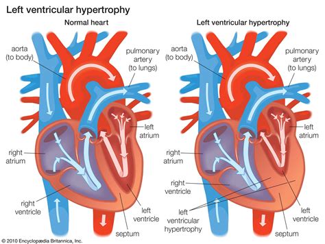 left ventricular dysfunction uptodate